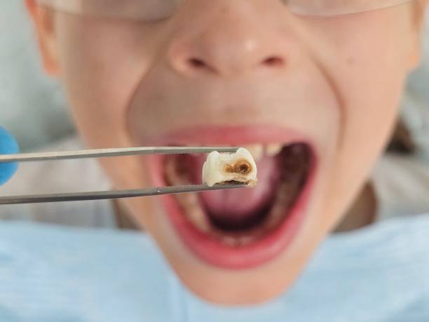 Best Urgent Care for Lost Fillings or Crowns in Canal Winchester, OH